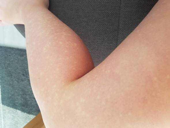 Weisse Hautflecken Kennt Die Jemand Korper Haut Weisse Hautflecken Kennt Die Jemand Korper Haut