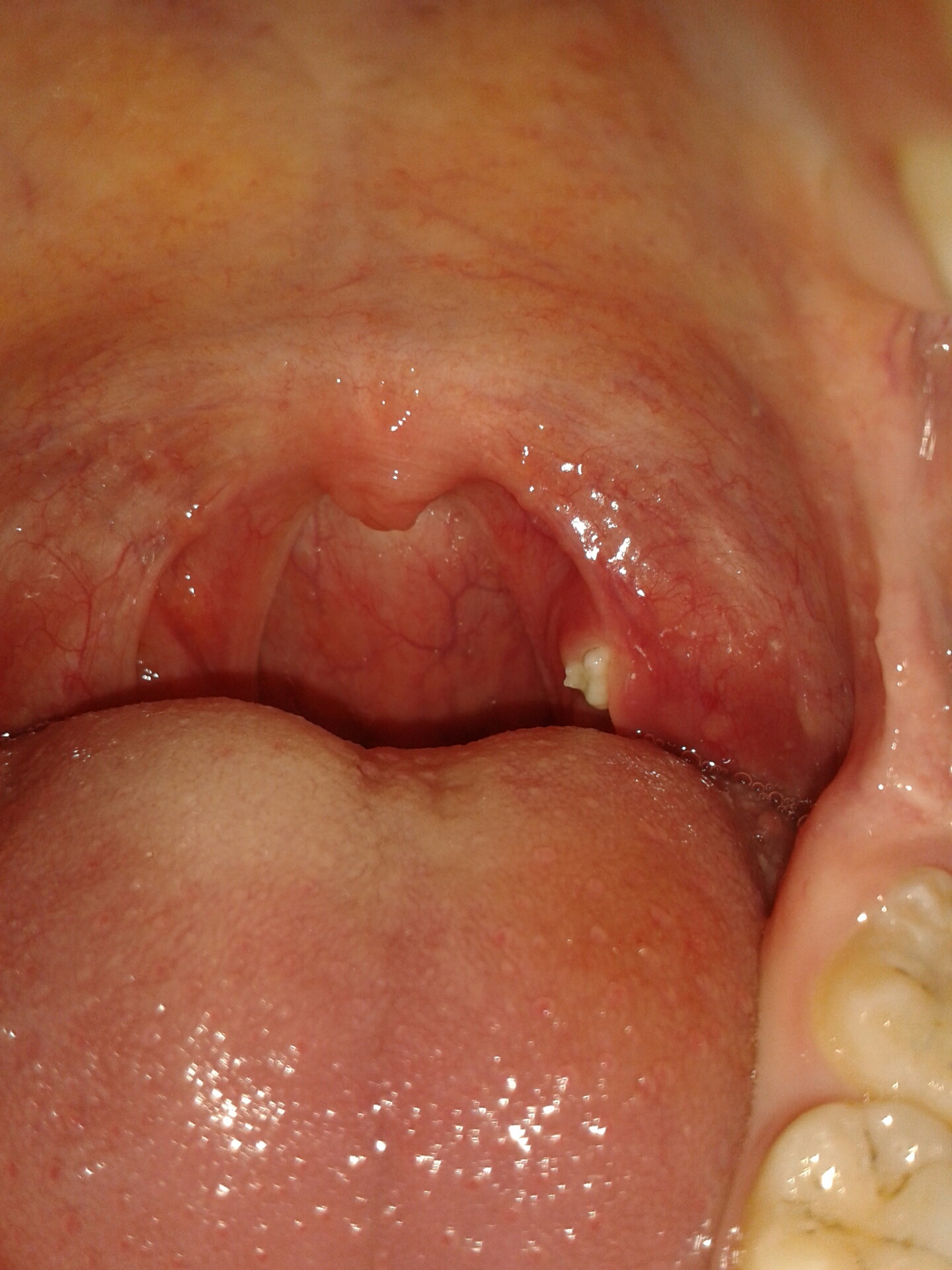 weiße konsestenz/ geschwür wächst am gaumen (?! halsweh! (Arzt, Eiter) weiße konsestenz/ geschwür wächst am gaumen (?! halsweh! (Arzt, Eiter)