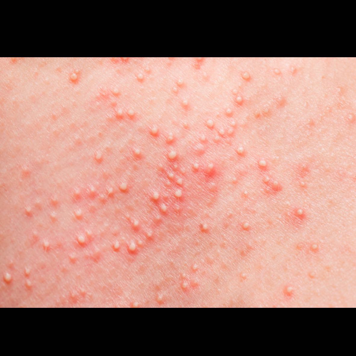 Weisse pickel am stirnbereich seit 1 jahr gehen nicht weg? (Haut, weiÃ?) pickel am stirn