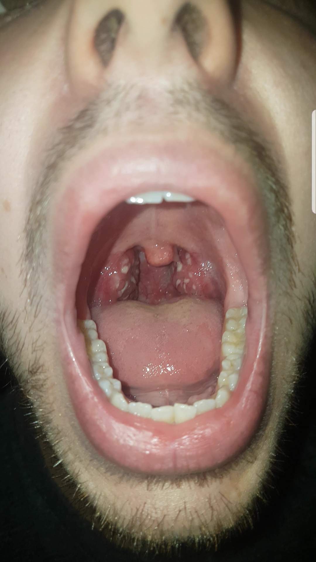 Weiße Pünktchen im Rachen? (krank, Arztbesuch, Mandelentzündung)