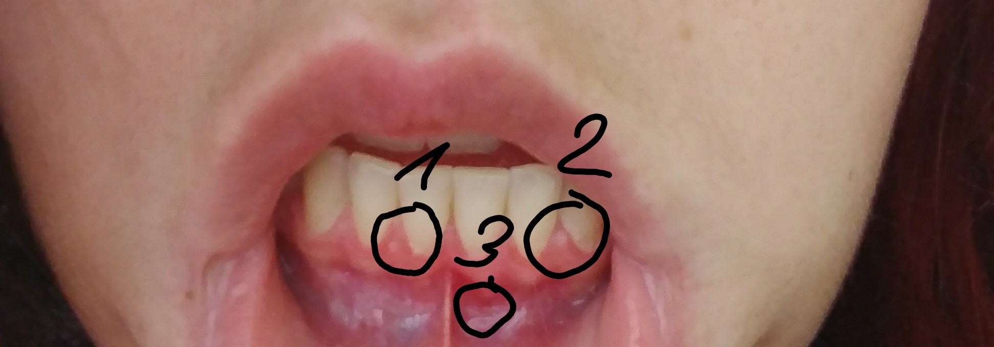 Zahnfleisch Weiße Punkte