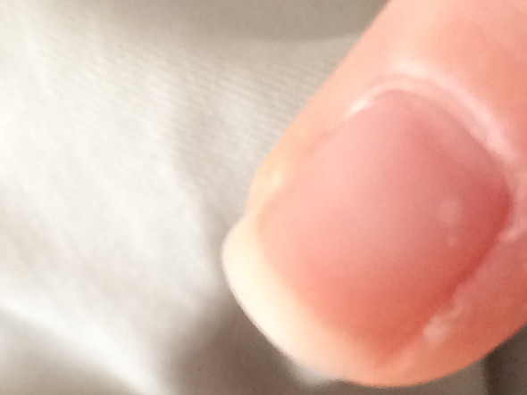 Weiße Punkte (Rechter kleiner Finger) - (Finger, Fingernägel, weiße Punkte)