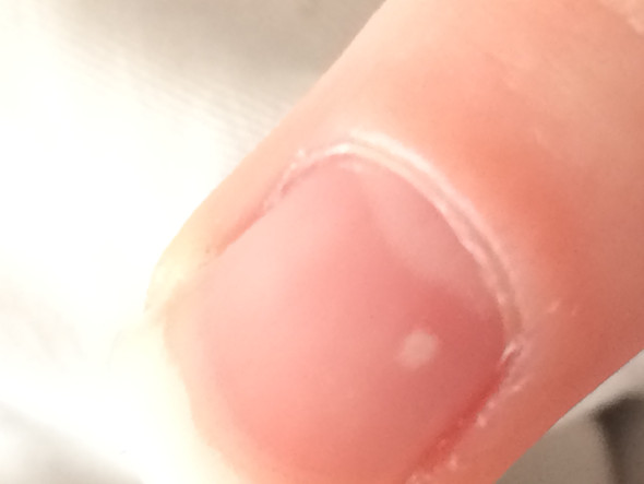 Weiße Punkte (Rechter Ringfinger) - (Finger, Fingernägel, weiße Punkte)