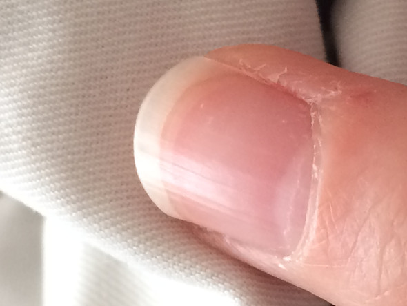 Weiße Punkte (Linker Ringfinger) - (Finger, Fingernägel, weiße Punkte)