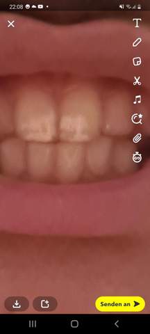 Weiße Punkte auf den schneide Zähnen?