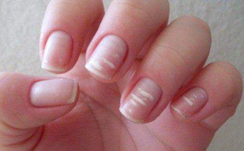 Weisse Punkte Auf Denn Finger Nageln Gesundheit Und Medizin Weisse Punkte Auf Denn Finger Nageln Gesundheit Und Medizin