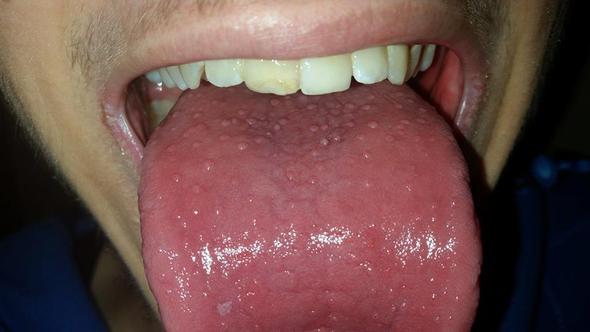 Aktuelles Bild der Zunge - (Krankheit, Pickel, rot)