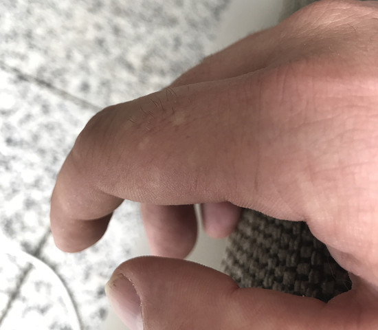 Handfläche weiße flecken Vitiligo (Weißfleckenkrankheit)