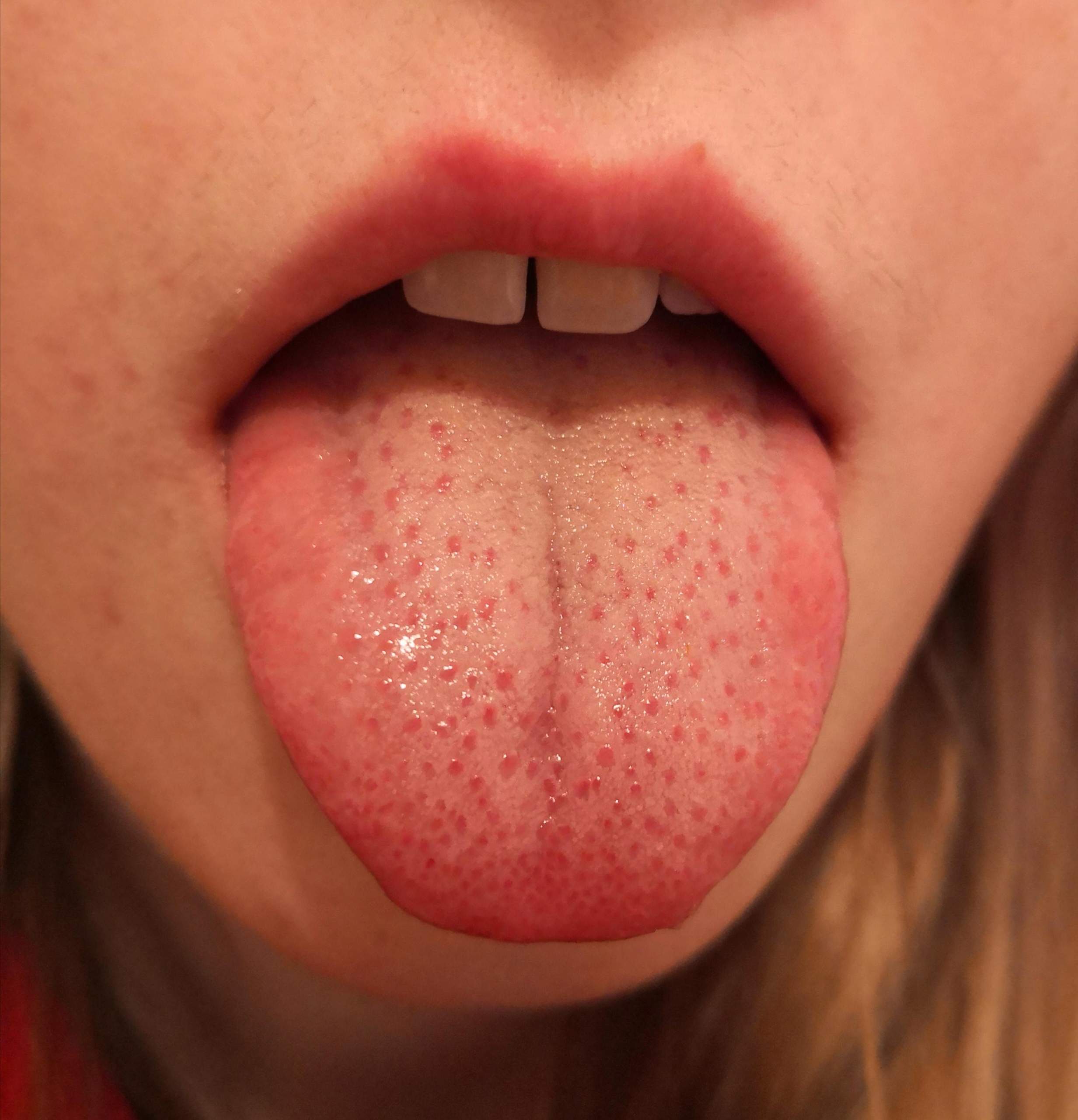 Weisse Punkte Auf Meiner Zunge Gesundheit Und Medizin Krankheit Weisse Punkte Auf Meiner Zunge Gesundheit Und Medizin Krankheit