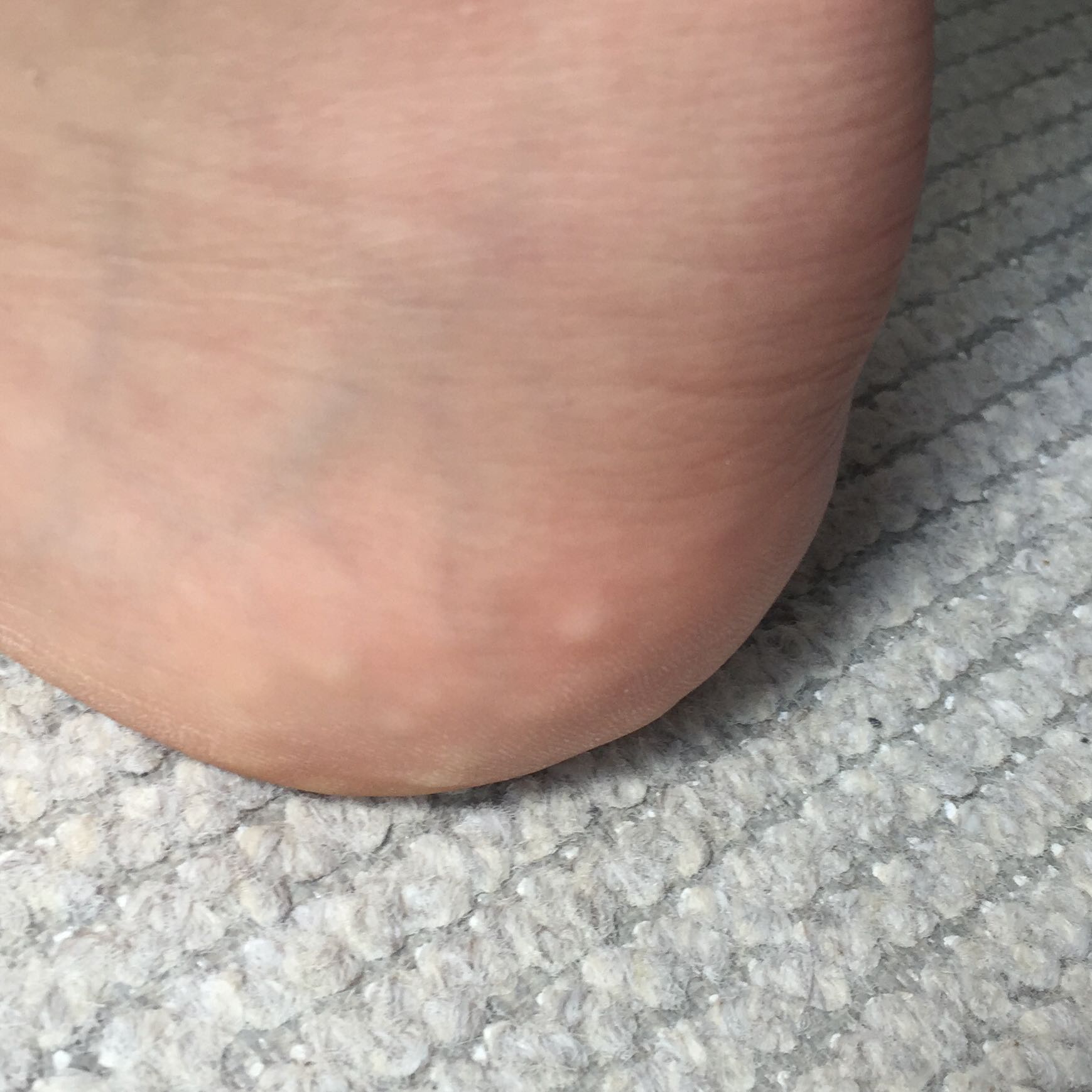 Weiße Punkte/ Blasen am Fers- Hilfe? (Medizin, Arzt, Füße)