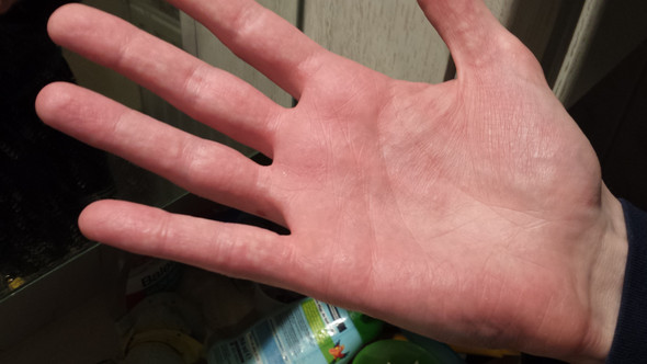 Weisse Punkte Blaschen Die Sich Dann Rot Verfarben Und Brennen Gesundheit Krankheit Hand Weisse Punkte Blaschen Die Sich Dann Rot Verfarben Und Brennen Gesundheit Krankheit Hand