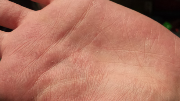 Weisse Punkte Blaschen Die Sich Dann Rot Verfarben Und Brennen Gesundheit Krankheit Hand Weisse Punkte Blaschen Die Sich Dann Rot Verfarben Und Brennen Gesundheit Krankheit Hand