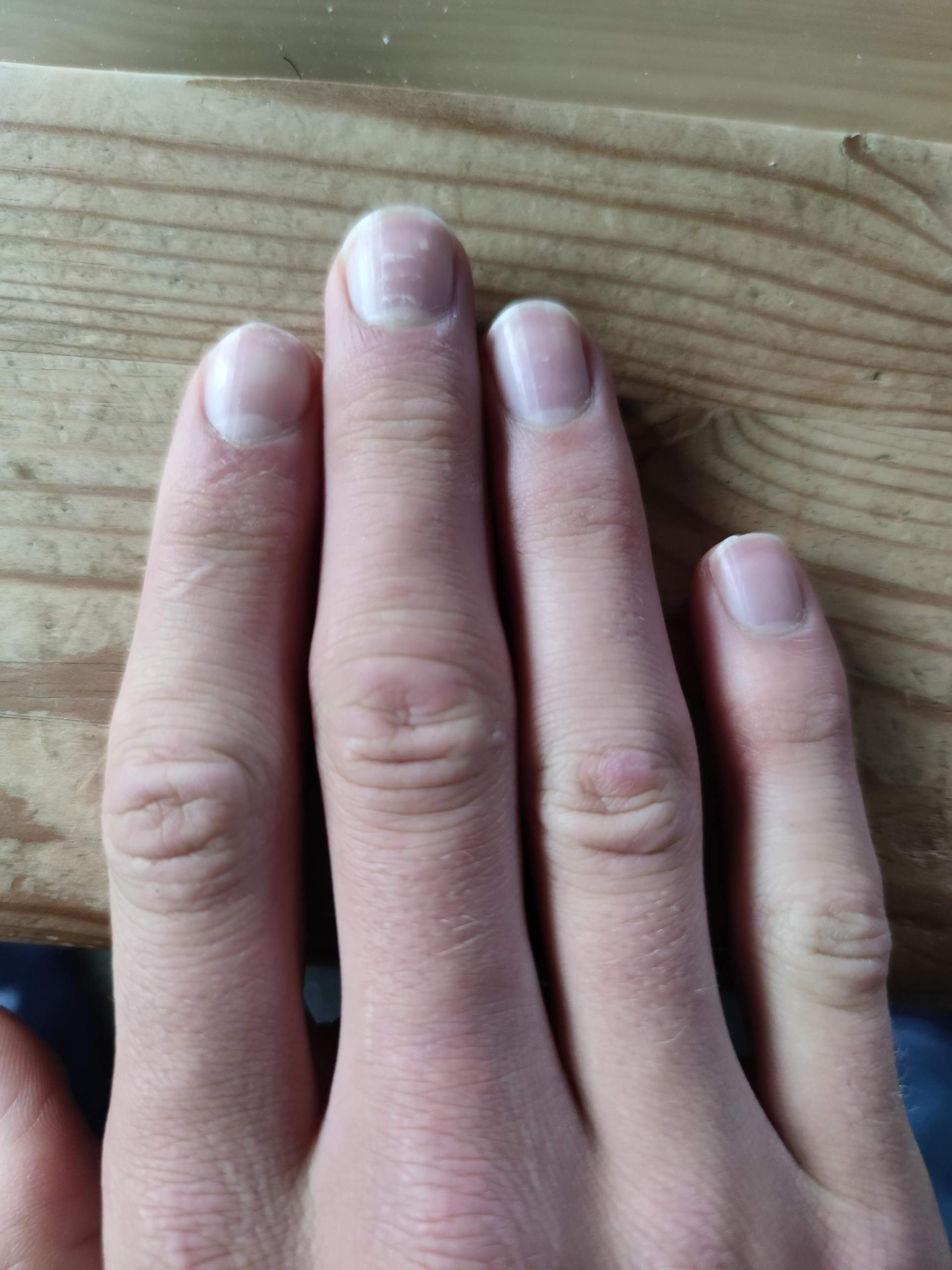 Weiße Punkte/Flecken auf Fingernagel? (Gesundheit und Medizin, Haut