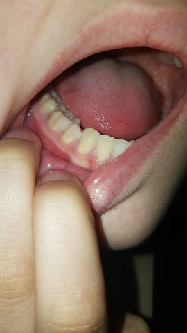 Weisse Rander Am Zahnfleisch Vom Erbrechen Zahne