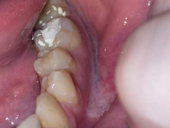 Weiße schmerzhafte Stelle am Zahnfleisch?