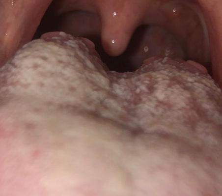 Weisse Zunge Mit Blaschen Gesundheit Und Medizin Gesundheit Blaeschen Weisse Zunge Mit Blaschen Gesundheit Und Medizin Gesundheit Blaeschen