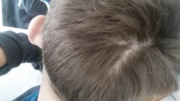 Weissen Fleck Loch Im Haar Gesundheit Haare Korper