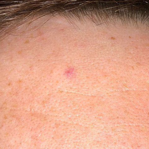 Weisser Hautkrebs Gesundheit Und Medizin Haut Krebs Weisser Hautkrebs Gesundheit Und Medizin Haut Krebs