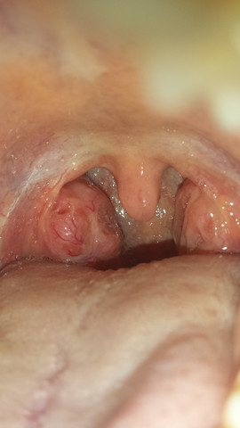 Weisser Belag Auf Den Mandeln Aber Keine Mandelentzundung Krankheit Weisser Belag Auf Den Mandeln Aber Keine Mandelentzundung Krankheit