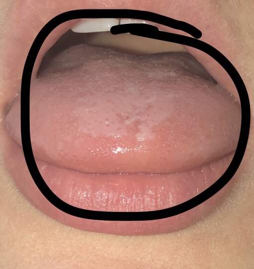 Weißer Belag auf Zunge und taubheitsgefühl?