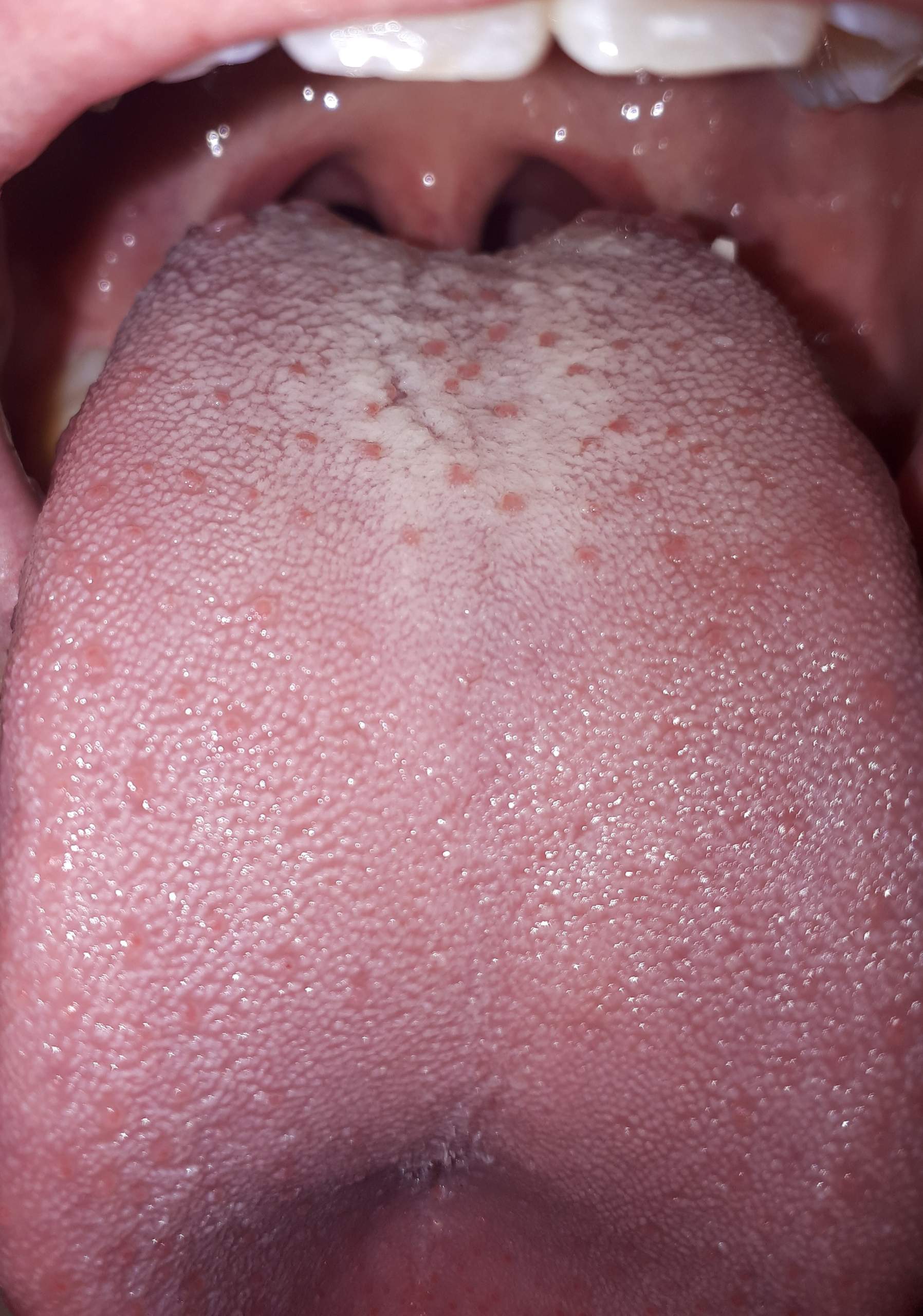 Weisser Belag Rote Flecken Auf Der Zunge Und Kratzendes Gefuhl Gesundheit Und Medizin Krankheit Zungenbelag Weisser Belag Rote Flecken Auf Der Zunge Und Kratzendes Gefuhl Gesundheit Und Medizin Krankheit Zungenbelag