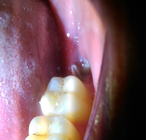Zahn - (Gesundheit und Medizin, Zähne, Zahnarzt)