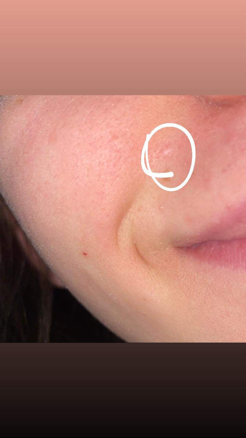 Weißer Fleck? (Gesundheit und Medizin, Gesundheit, Pickel)