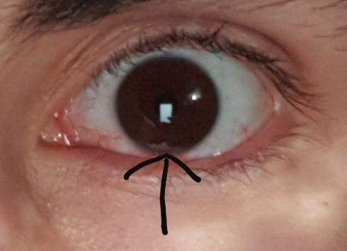 Weisser Fleck Am Auge Gesundheit Medizin Augen Weisser Fleck Am Auge Gesundheit Medizin Augen