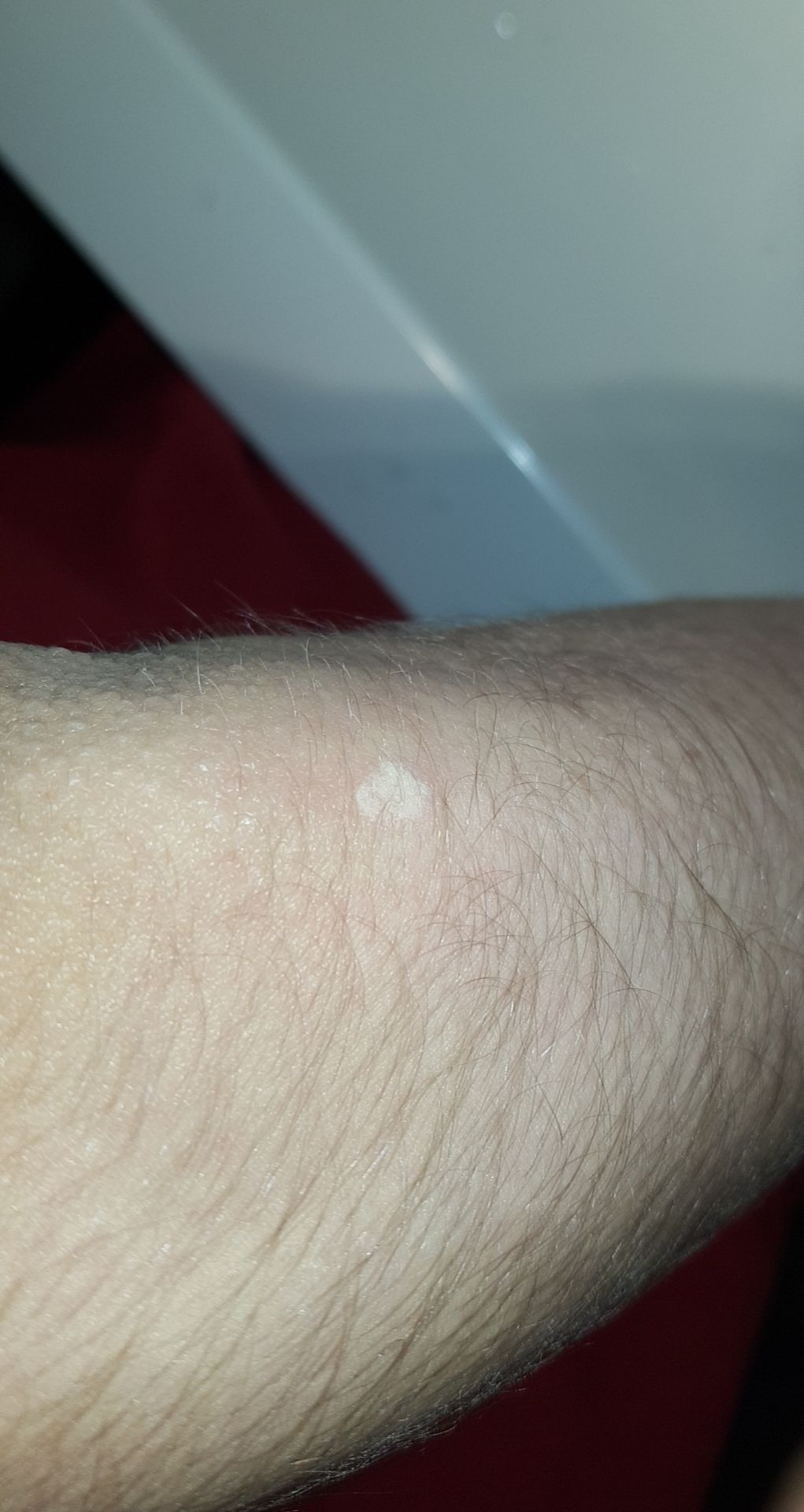 Weißer Fleck auf der Haut? (Gesundheit und Medizin, Gesundheit, Arzt)