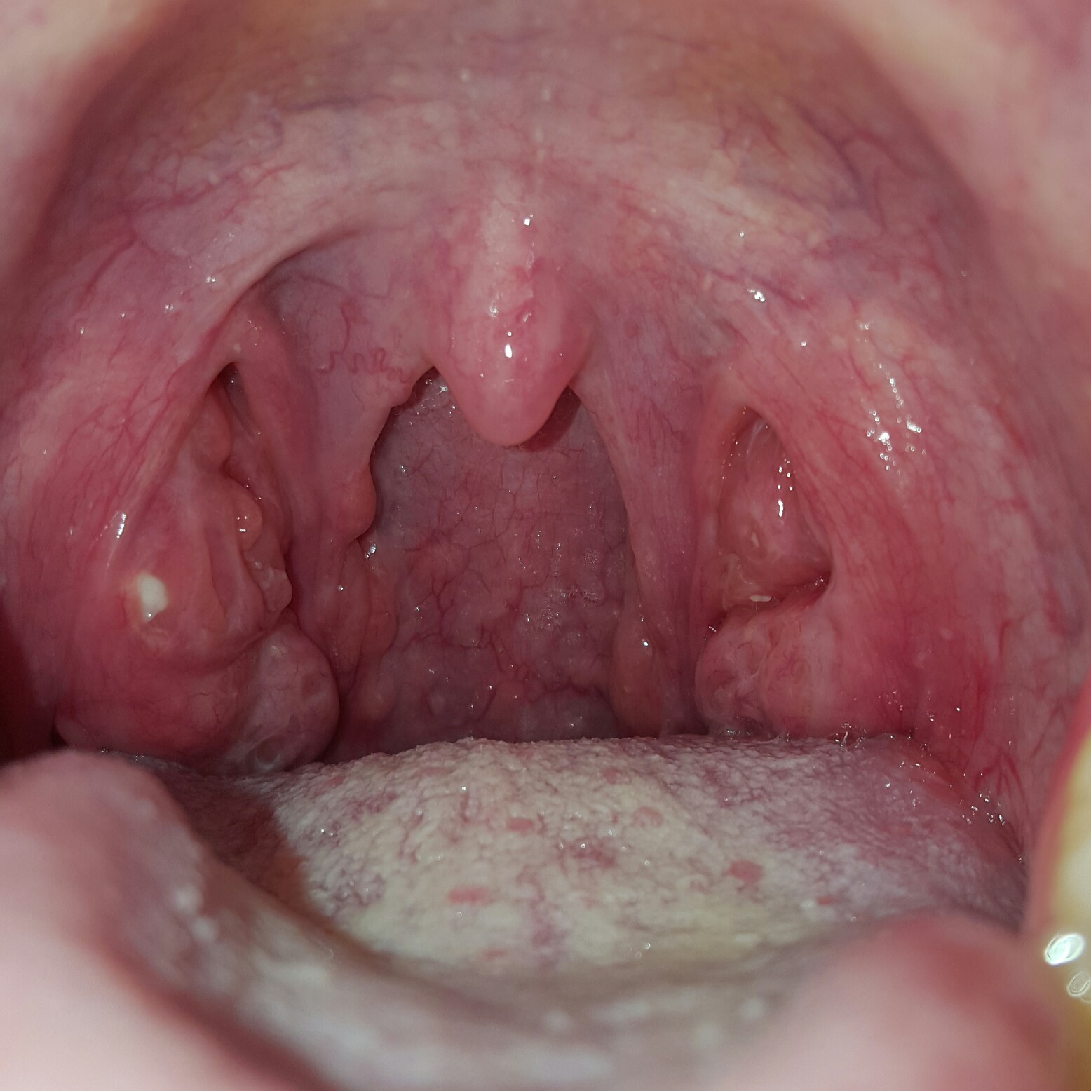 Weißer Fleck auf Mandeln mit Halsschmerzen? (Arzt) Weißer Fleck auf Mandeln mit Halsschmerzen? (Arzt)