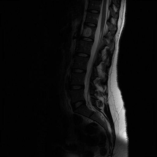 Weißer Fleck auf MRT Bildern? (Gesundheit und Medizin, Medizin, Arzt)