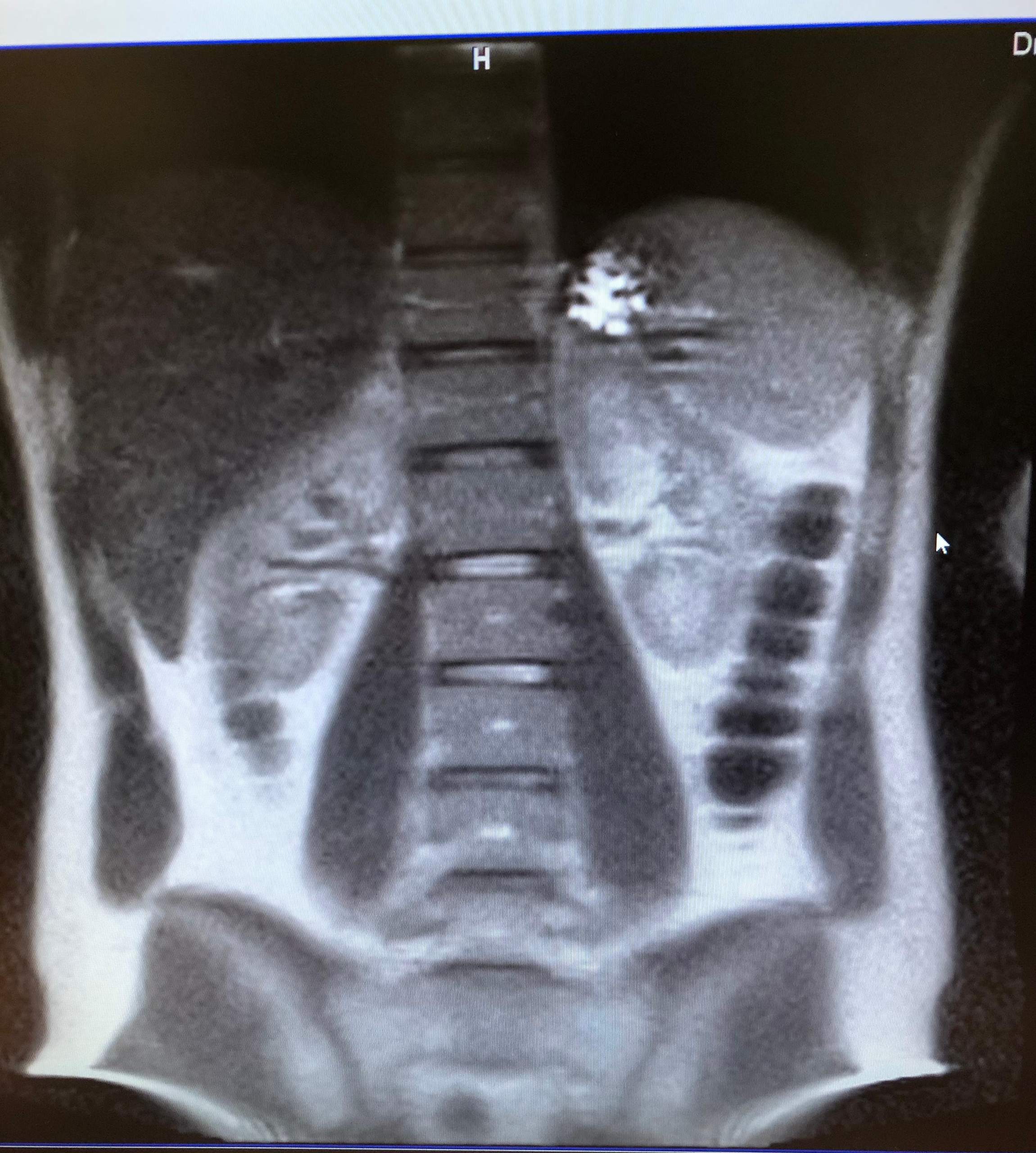 Weißer Fleck MRT? (Gesundheit und Medizin, Medizin, Arzt)