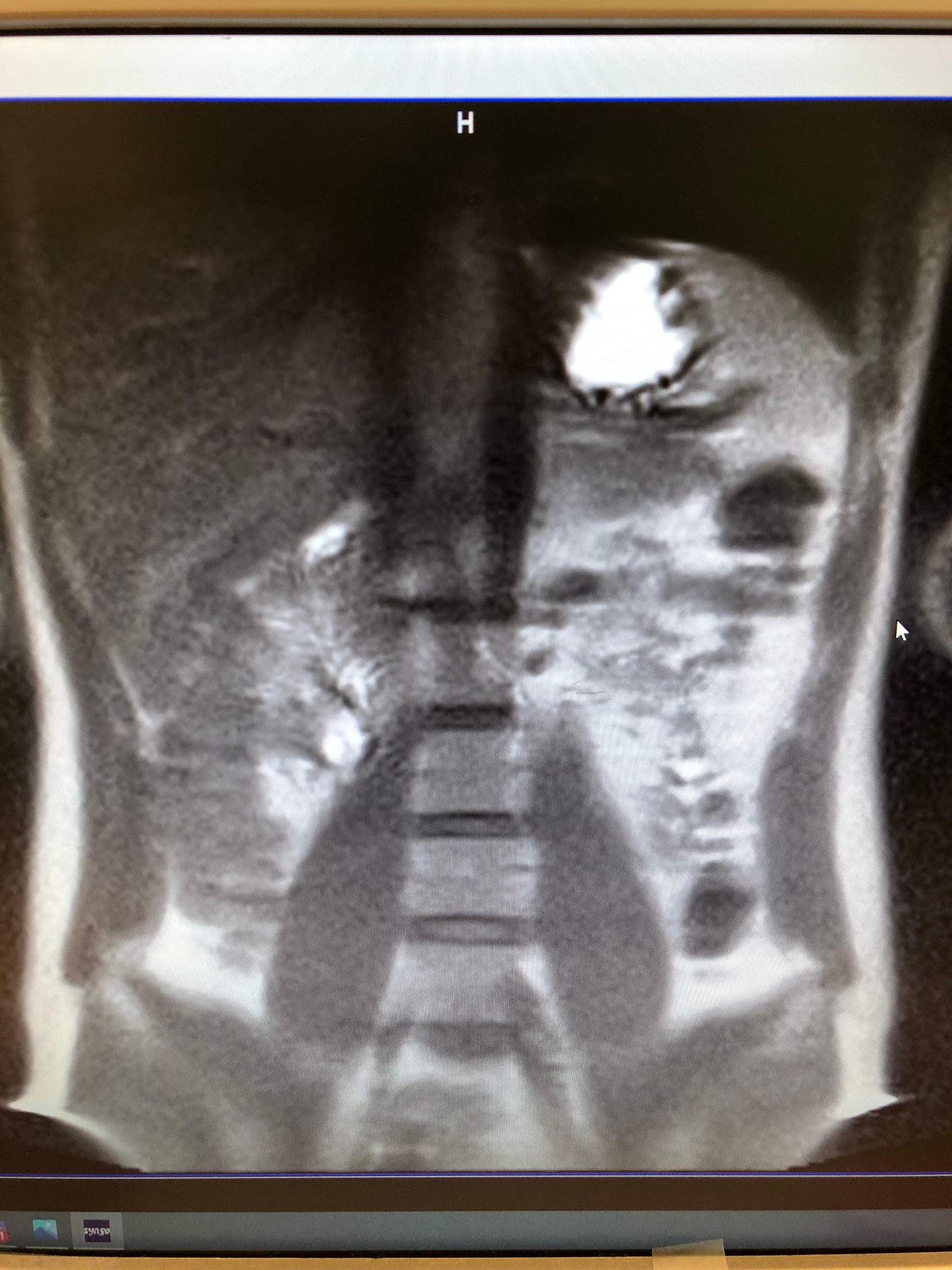 Weißer Fleck MRT? (Gesundheit und Medizin, Medizin, Arzt)