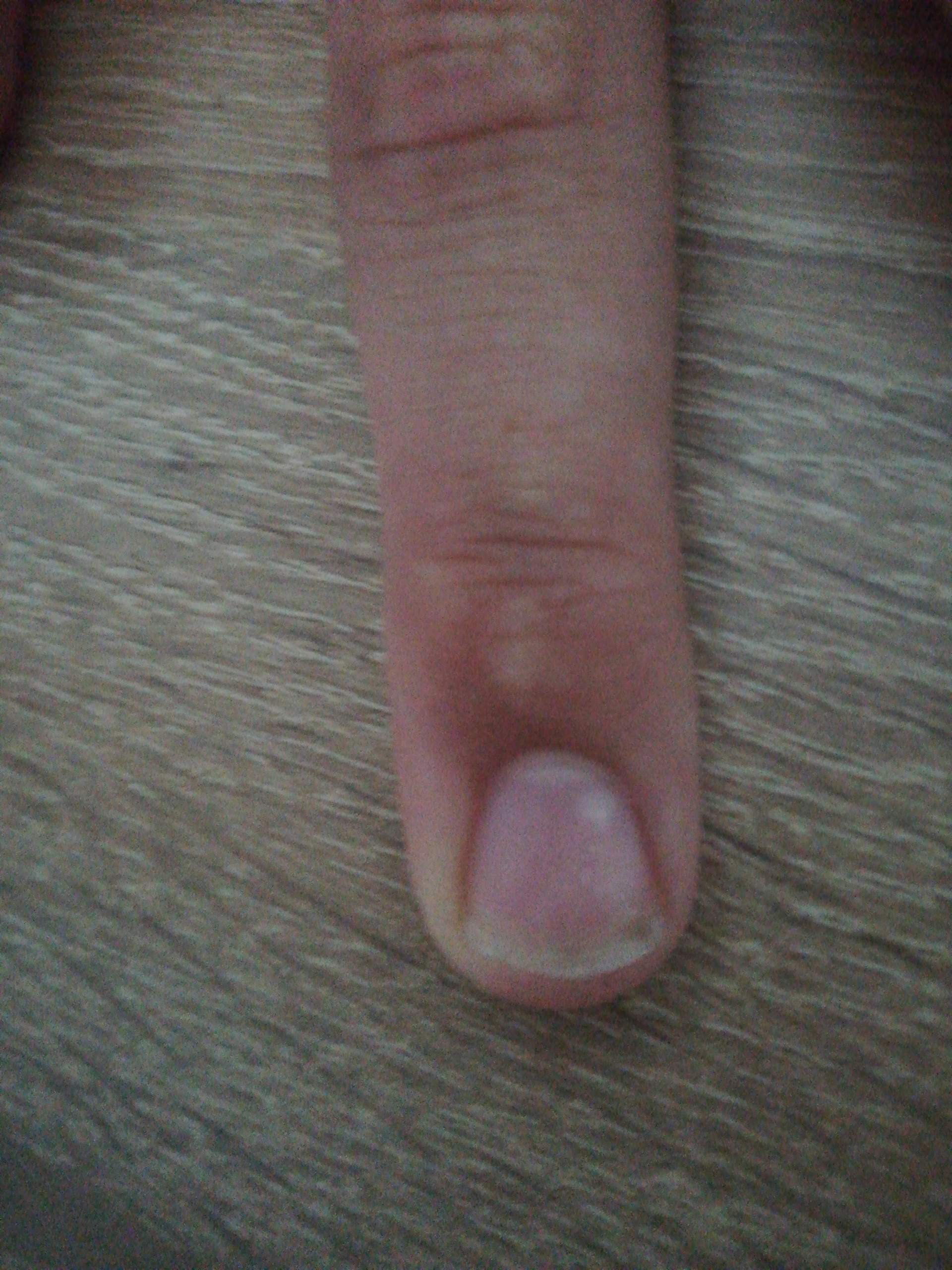weisser fleck unterm fingernagel gesundheit und medizin gesundheit