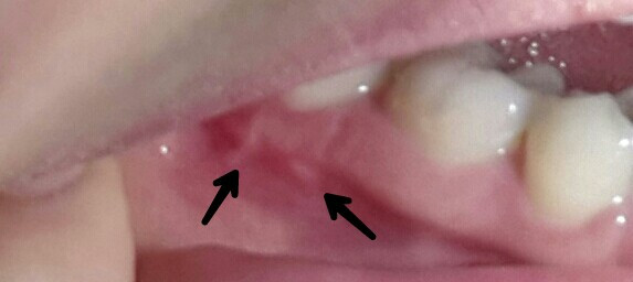 Zahnfleich-Knubbel - (Zahnfleisch, Zahnfleischentzündung)