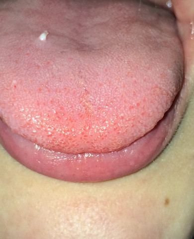 Zunge der knötchen auf Fibrom: Ursachen,