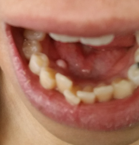 Knoten2 - (Zahnarzt, Knoten, Mundhöhle)