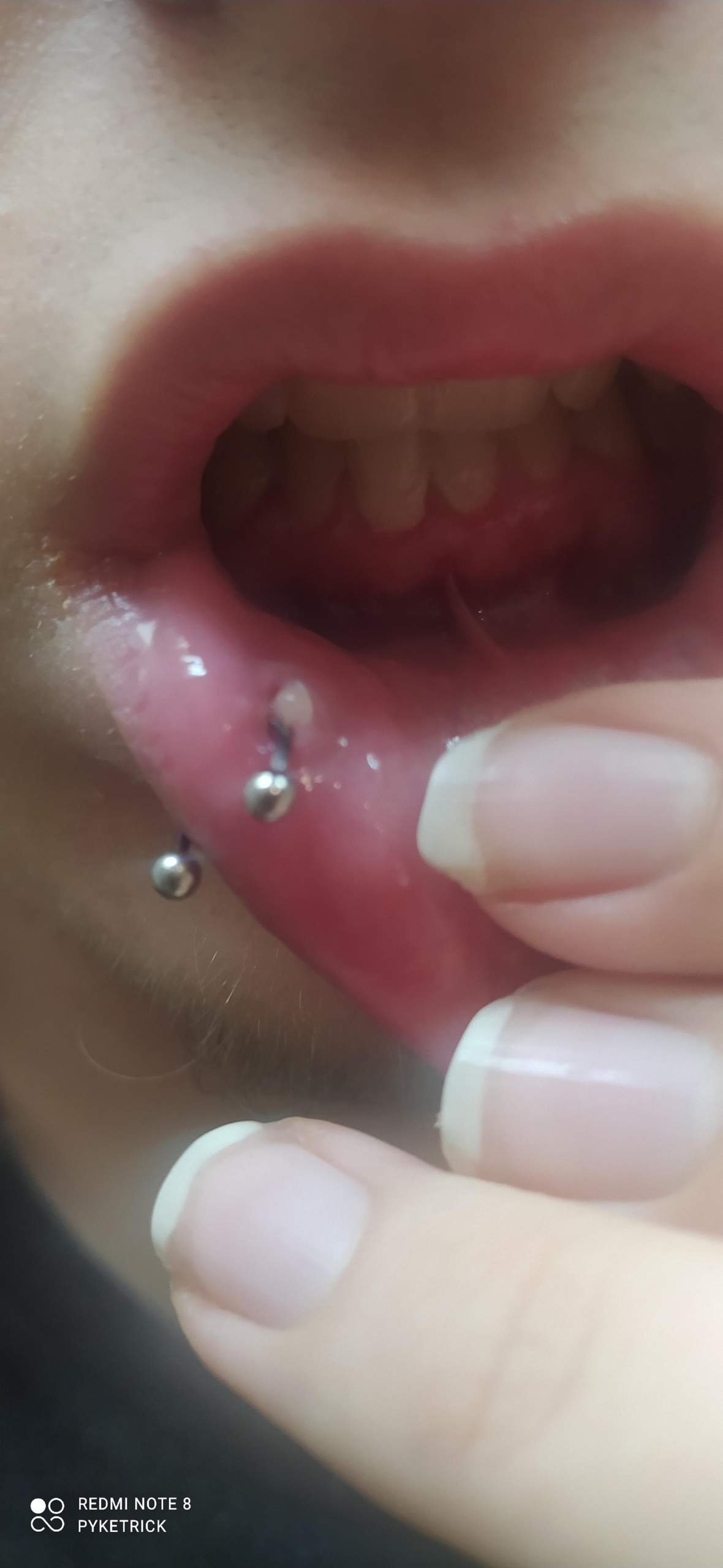 weisser knubbel am lippenpiercing piercing piercer piercingstudio