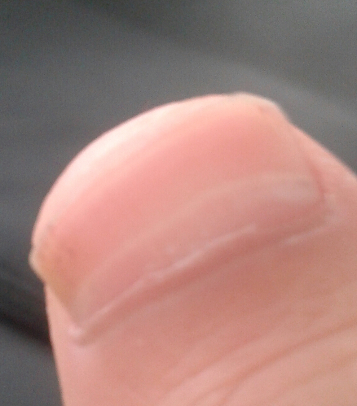 Weißer langer Streifen auf Fingernagel (Gesundheit, Arzt, Haut)