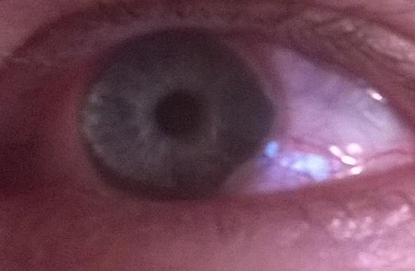 Weisser Milchiger Rand Im Auge Augen