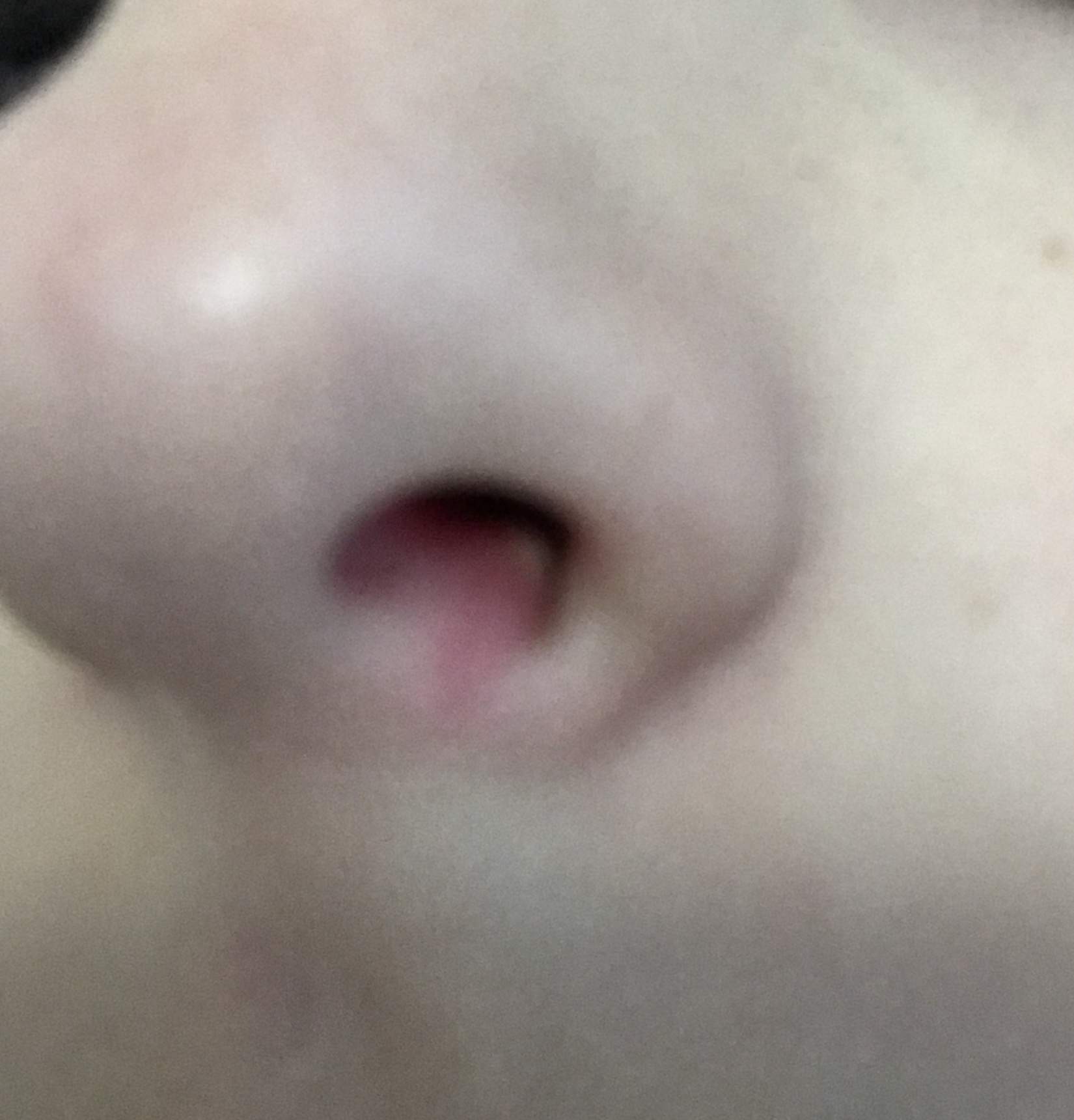 Weisser Pickel In Der Nase Gesundheit Haut Weisser Pickel In Der Nase Gesundheit Haut