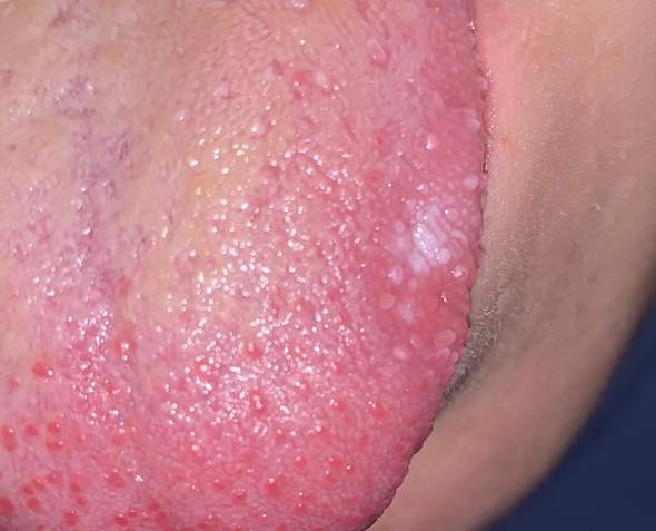 Weisser Punkt Auf Der Zunge Seitlich Gesundheit Und Medizin Weisser Punkt Auf Der Zunge Seitlich Gesundheit Und Medizin
