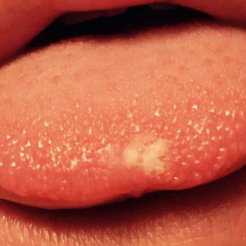Weisser Punkt Auf Zunge Was Ist Das Gesundheit Medizin Arzt Weisser Punkt Auf Zunge Was Ist Das Gesundheit Medizin Arzt