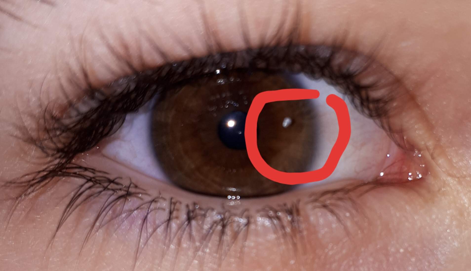 Weißer Punkt Im Auge Iris