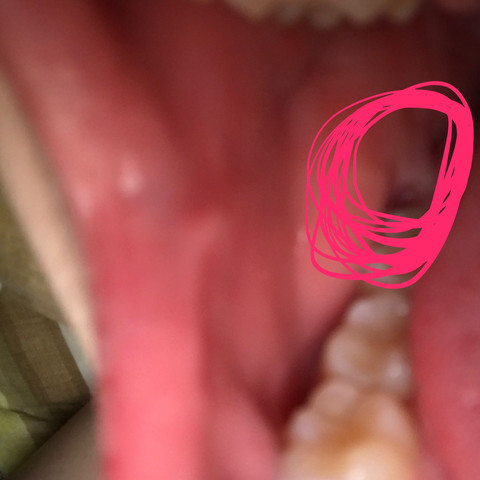 Weißes Zeug hinter meinem Backenzahn im Mund  - (Arzt, Zähne, Mund)