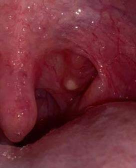 Weisser Punkt Im Rachen Rechts Gesundheit Und Medizin Gesundheit Rauchen Weisser Punkt Im Rachen Rechts Gesundheit Und Medizin Gesundheit Rauchen