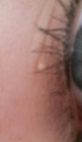 Was ist das für ein weißer Punkt? - (Augen, Pickel)
