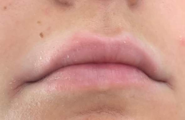 Weisser Rand Uber Lippe Verfarbung