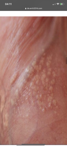 Weisser Ring An Der Inneren Vorhaut Penis Pickel Weiss Weisser Ring An Der Inneren Vorhaut Penis Pickel Weiss