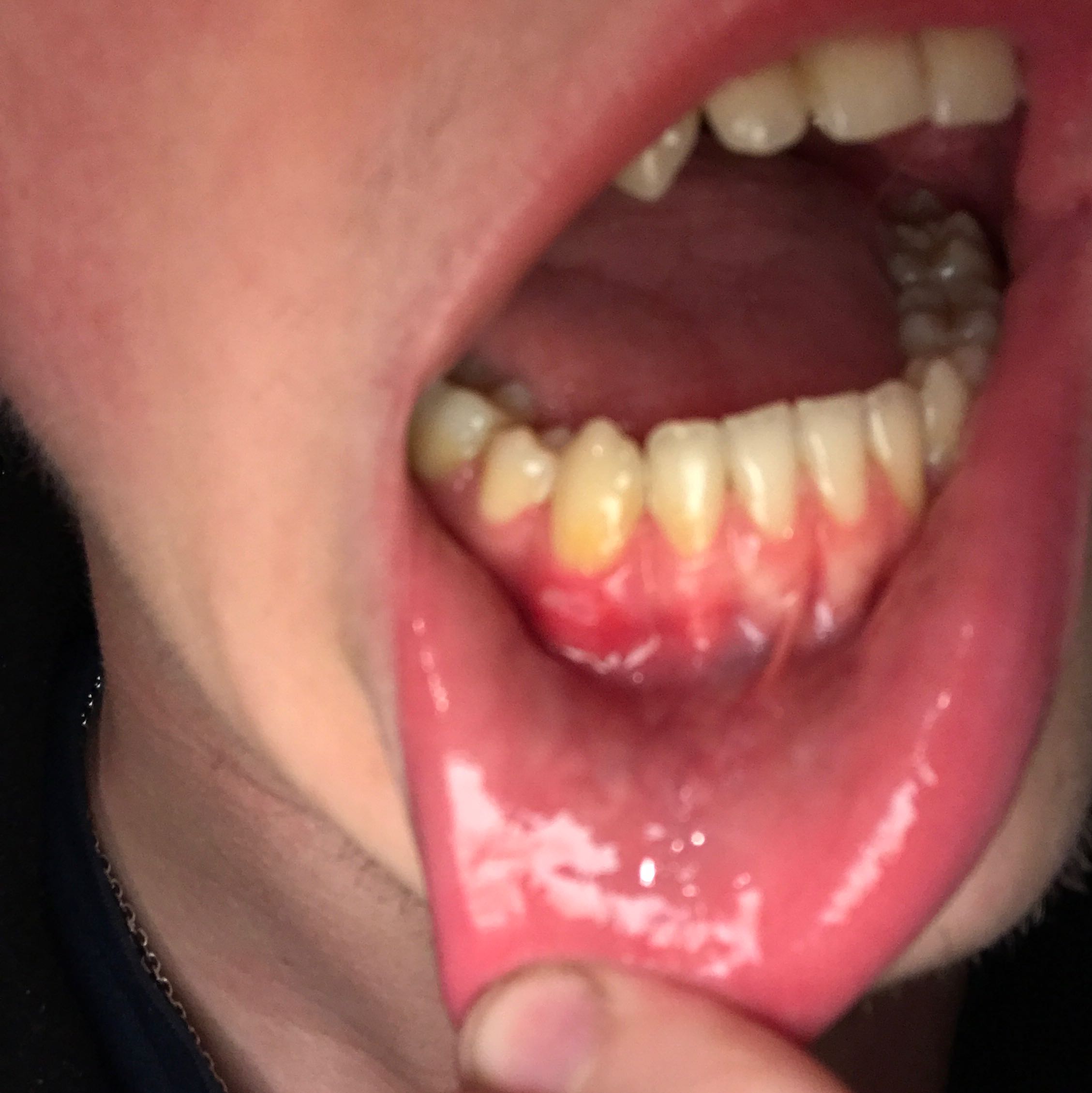 Weisser Streifen Im Zahnfleisch Entzundung Bild